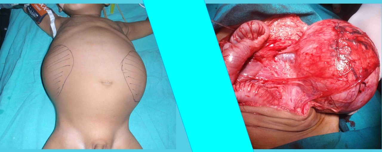 Pediatric Onco-Surgery